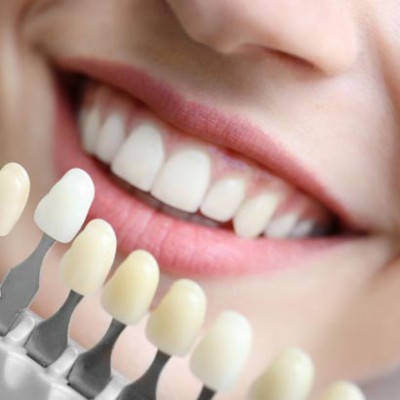 Bọc răng sứ thẩm mỹ