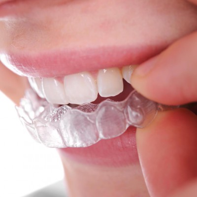 Niềng răng không mắc cài